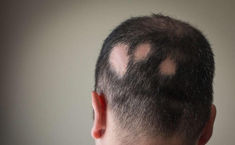 андрогенна алопеція