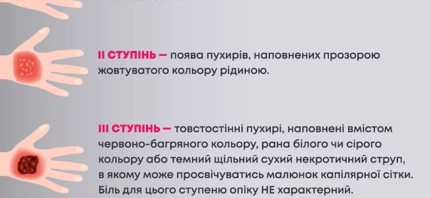 Перша допомога при опіках в домашніх умовах: ключові поради і дії