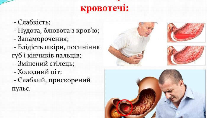 Шлунково-кишкова кровотеча: ефективна перша допомога і поради Шлунково-кишкова кровотеча: ефективна перша допомога і поради