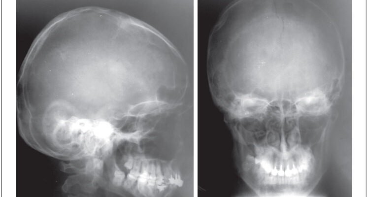 Вплив тріщини черепа: наслідки та відновлення після травми Вплив тріщини черепа: наслідки та відновлення після травми