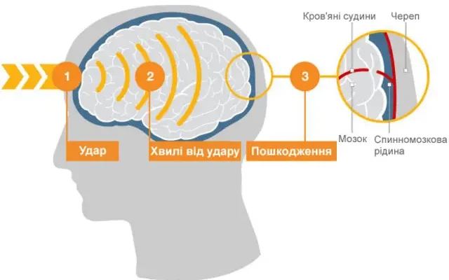 Удар по голові: наслідки та як вберегтися від травмуючих ефектів