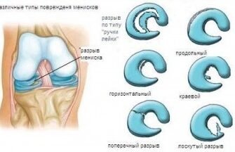 Видалення меніска: які наслідки очікувати та як їх уникнути?