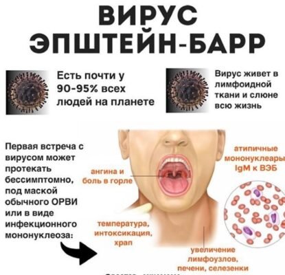 Вірус Епштейна-Барр: наслідки та вплив на здоров’я людини Вірус Епштейна-Барр: наслідки та вплив на здоров’я людини
