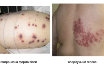 Наслідки вітрянки: що варто знати про вплив хвороби на організм