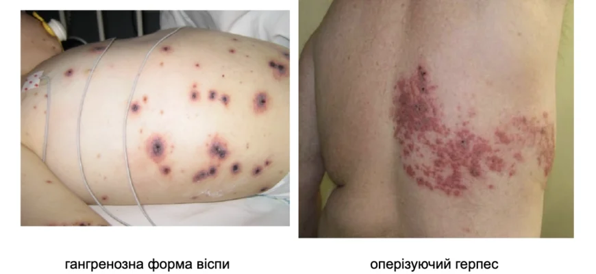 Наслідки вітрянки: як хвороба впливає на здоров’я дорослих і дітей Наслідки вітрянки: як хвороба впливає на здоров’я дорослих і дітей