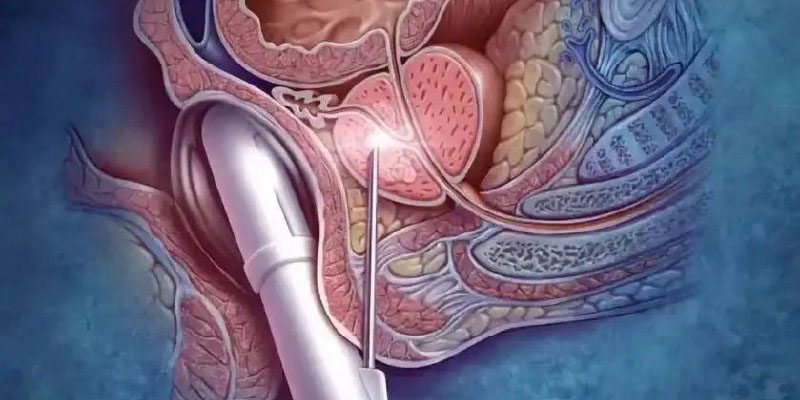 Біопсія простати: наслідки та важливі поради для пацієнтів Біопсія простати: наслідки та важливі поради для пацієнтів