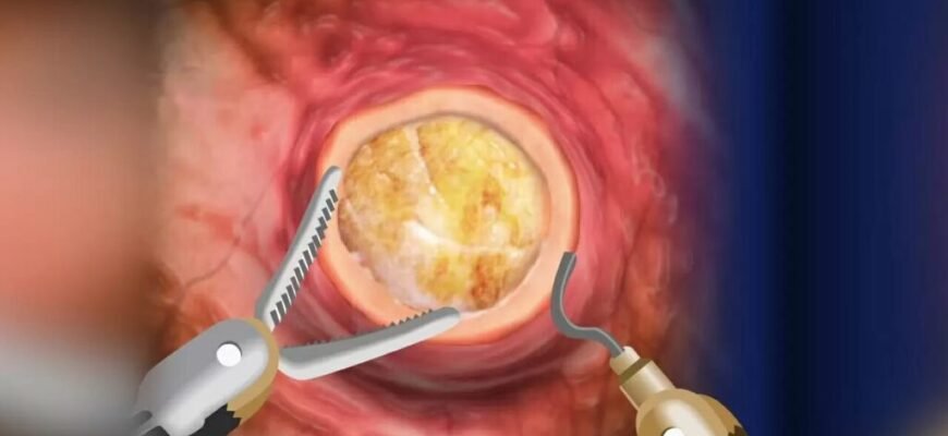 Наслідки після видалення міоми: як впливає операція на жіноче здоров’я Наслідки після видалення міоми: як впливає операція на жіноче здоров’я