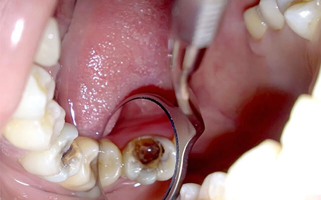 “Видалення нерва зуба: наслідки, які варто знати перед процедурою”