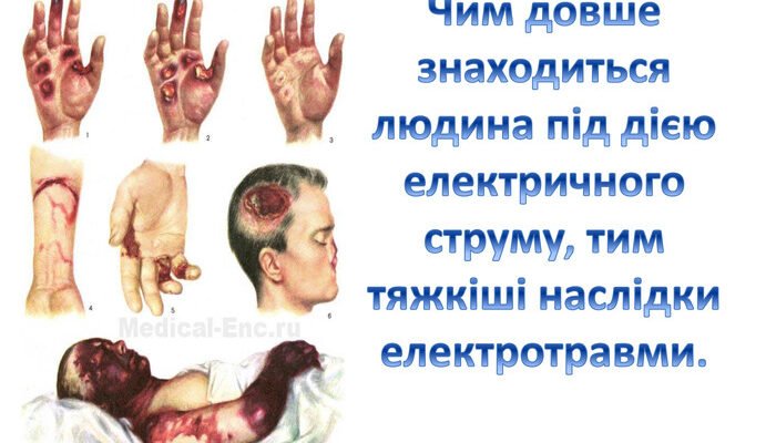 Наслідки ураження електричним струмом: загрози та відновлення Наслідки ураження електричним струмом: загрози та відновлення
