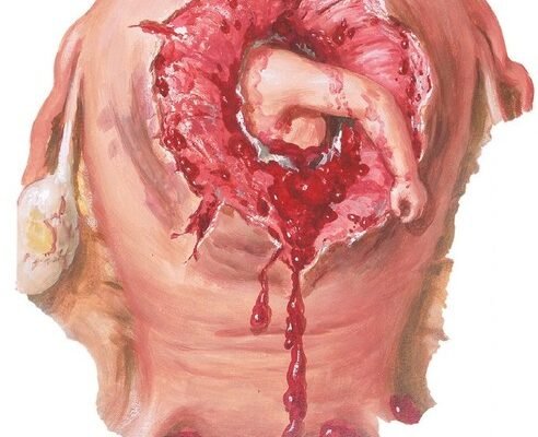 Наслідки розриву шийки матки: що потрібно знати для здоров’я