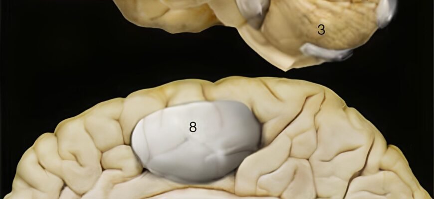 Кіста головного мозку: наслідки для здоров’я та можливі ускладнення Кіста головного мозку: наслідки для здоров’я та можливі ускладнення