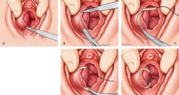 Наслідки видалення бартолінової залози: що чекає після операції? Наслідки видалення бартолінової залози: що чекає після операції?