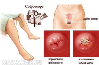 Біопсія шийки матки: наслідки процедури та подальший догляд