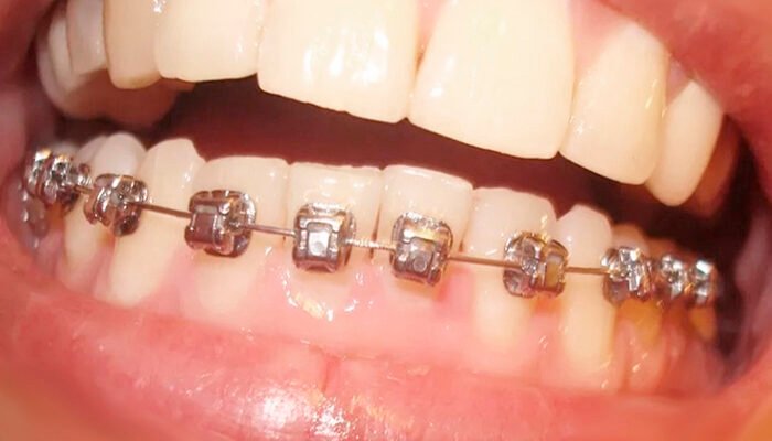 Чи можна ставити брекети на одну щелепу: що кажуть стоматологи?