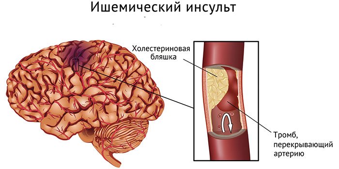 Інфаркт головного мозку: наслідки та методи реабілітації пацієнтів