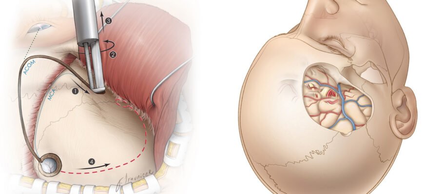 Наслідки трепанації черепа: що очікувати після операції? Наслідки трепанації черепа: що очікувати після операції?