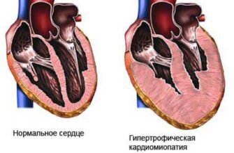 Збільшене серце: наслідки та вплив на здоров’я людини