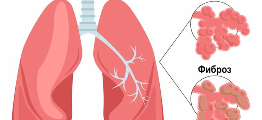 Чи можна вилікувати фіброз легень: сучасні методи та підходи Чи можна вилікувати фіброз легень: сучасні методи та підходи