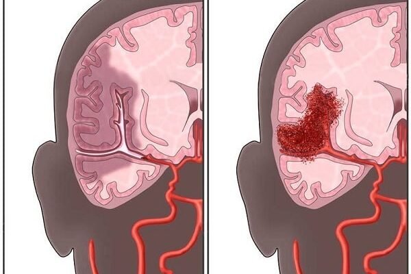 Наслідки крововиливу в мозок: що очікувати після інсульту?