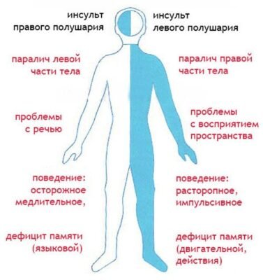Наслідки ішемічного інсульту: як впливають на життя пацієнтів Наслідки ішемічного інсульту: як впливають на життя пацієнтів