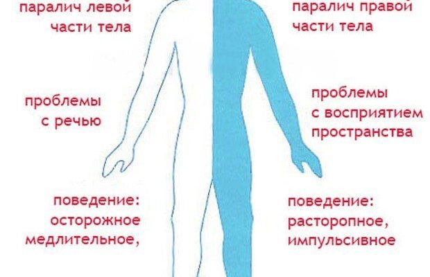 Наслідки ішемічного інсульту: розуміння, профілактика та відновлення