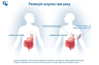 Чи можна вилікувати рак шлунка: сучасні підходи та методики лікування