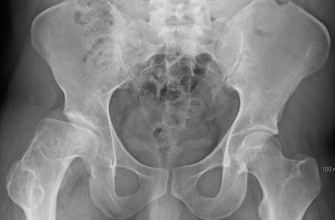 Хвороба Пертеса: наслідки та вплив на здоров’я дитини