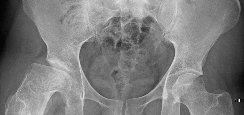 Хвороба Пертеса: наслідки та вплив на здоров’я дитини