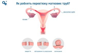 Перев’язування маткових труб: наслідки та вплив на здоров’я жінки