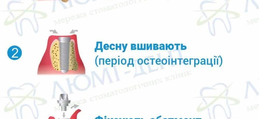 Наслідки імплантації зубів: що варто знати перед процедурою