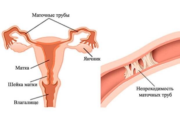 Наслідки видалення маткової труби: що варто знати про здоров’я