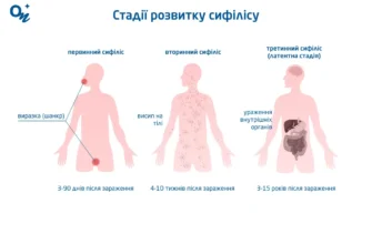 Сифіліс: наслідки та ускладнення, про які варто знати всім