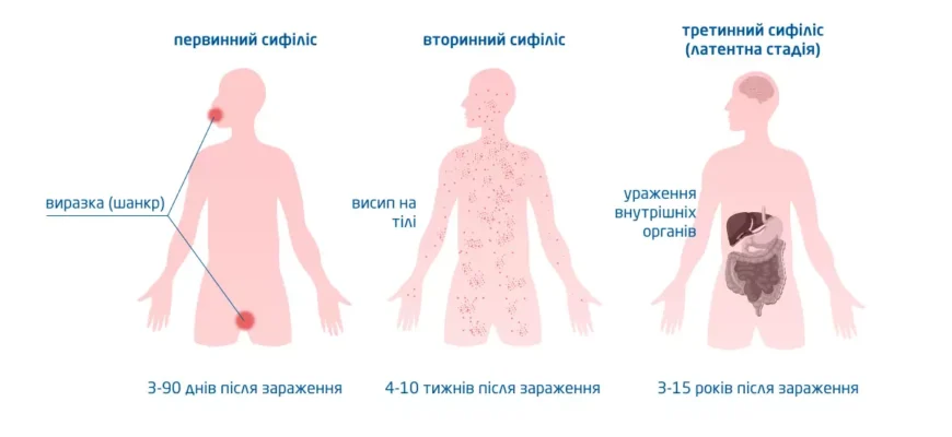 Сифіліс: наслідки та ускладнення, про які варто знати всім Сифіліс: наслідки та ускладнення, про які варто знати всім