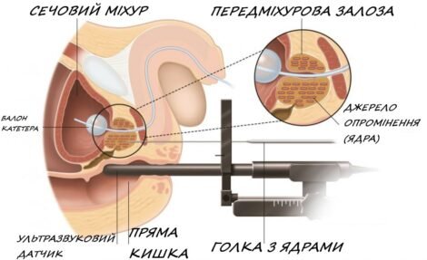 Наслідки променевої терапії: вплив на здоров’я та відновлення