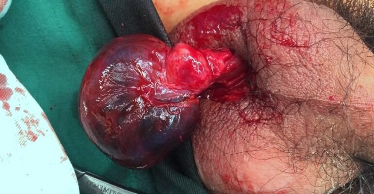 Перекрут яєчка: наслідки, про які варто знати кожному чоловікові