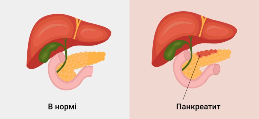 Чи можна вилікувати хронічний панкреатит: факти та поради лікарів Чи можна вилікувати хронічний панкреатит: факти та поради лікарів