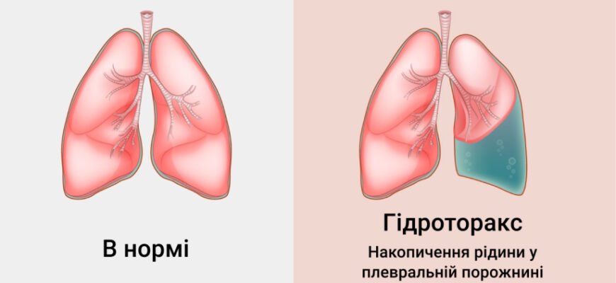 Вода в легенях: наслідки та загрози для вашого здоров’я