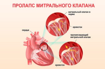 Чи можна вилікувати пролапс мітрального клапана: сучасні методи та поради