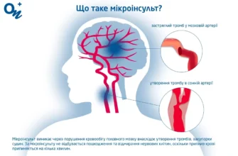 Мікроінсульт: наслідки, які варто знати для запобігання ускладнень