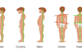 Наслідки сколіозу: як кривизна хребта впливає на здоров’я людини