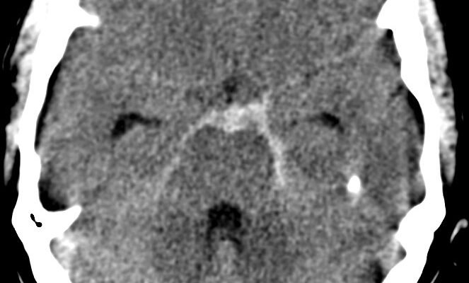 Комплексний огляд: наслідки субарахноїдального крововиливу для здоров’я Комплексний огляд: наслідки субарахноїдального крововиливу для здоров’я