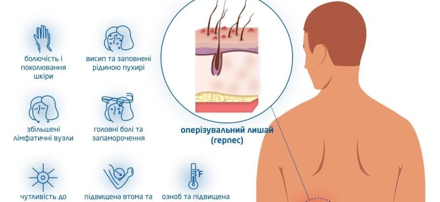 Чи можна гріти оперізуючий лишай: небезпеки та рекомендації