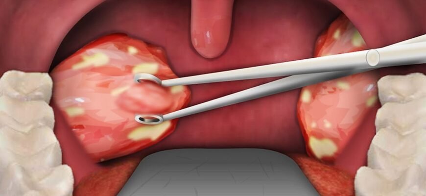 Наслідки видалення гланд: вплив на здоров’я та життя після операції Наслідки видалення гланд: вплив на здоров’я та життя після операції