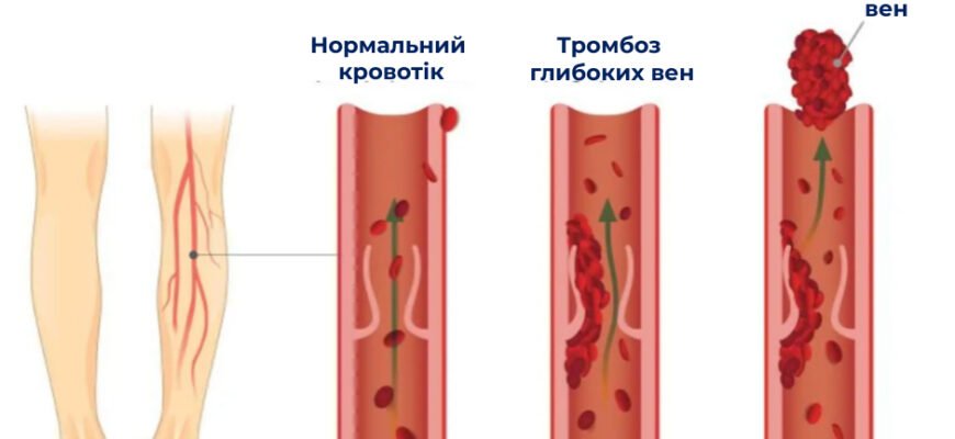 Наслідки тромбозу: ключові ризики та шляхи їх подолання