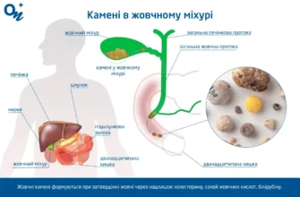 Чи можна розчинити камені в жовчному міхурі: ефективні методи лікування