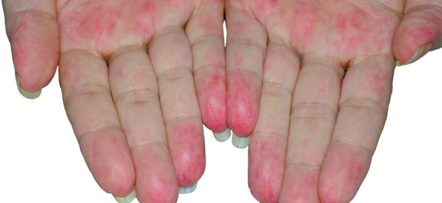 Чи можна вилікувати васкуліт: сучасні методи та перспективи лікування Чи можна вилікувати васкуліт: сучасні методи та перспективи лікування