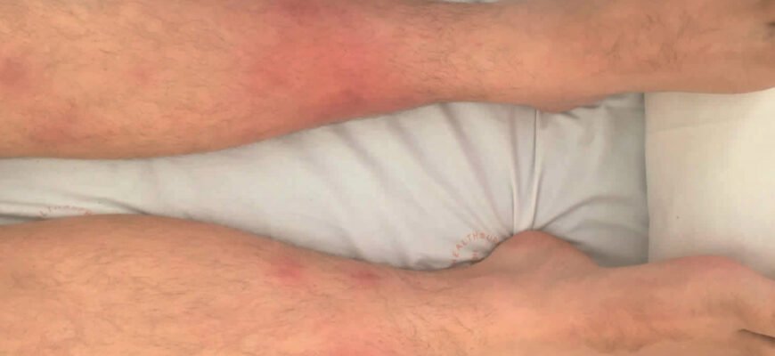 Вузлова еритема: наслідки для здоров’я та важливі рекомендації