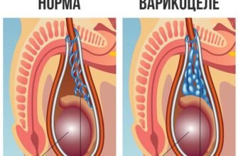 Чи можна мати дітей при варикоцеле: розвінчуємо міфи та факти